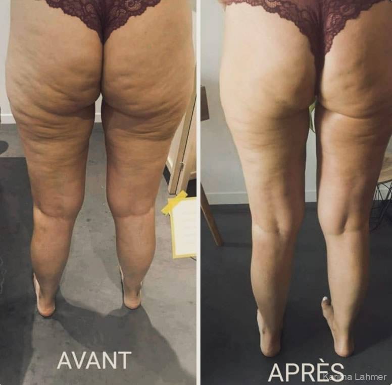 Massage Minceur/Anti-Cellulite